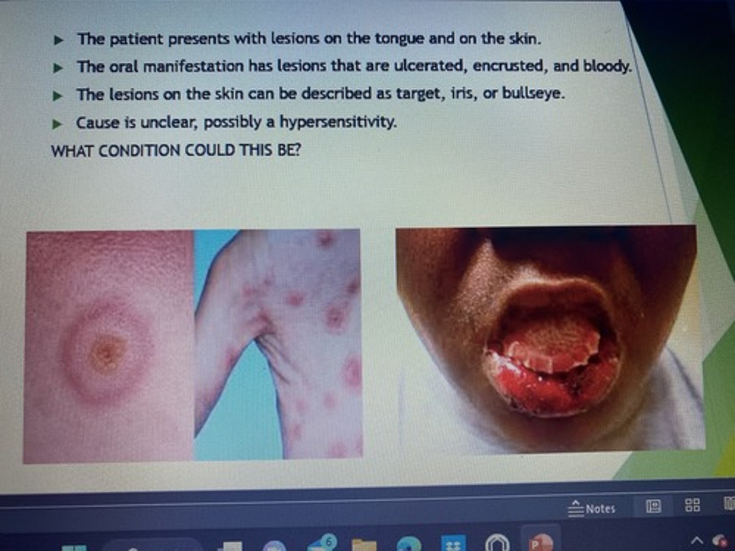 <p>The patient presents with lesions on the tongue and on the skin.</p><p>The oral manifestation has lesions that are ulcerated, encrusted, and bloody.</p><p>The lesions on the skin can be described as target, iris, or bullseye.</p><p>Cause is unclear, possibly a hypersensitivity.</p>