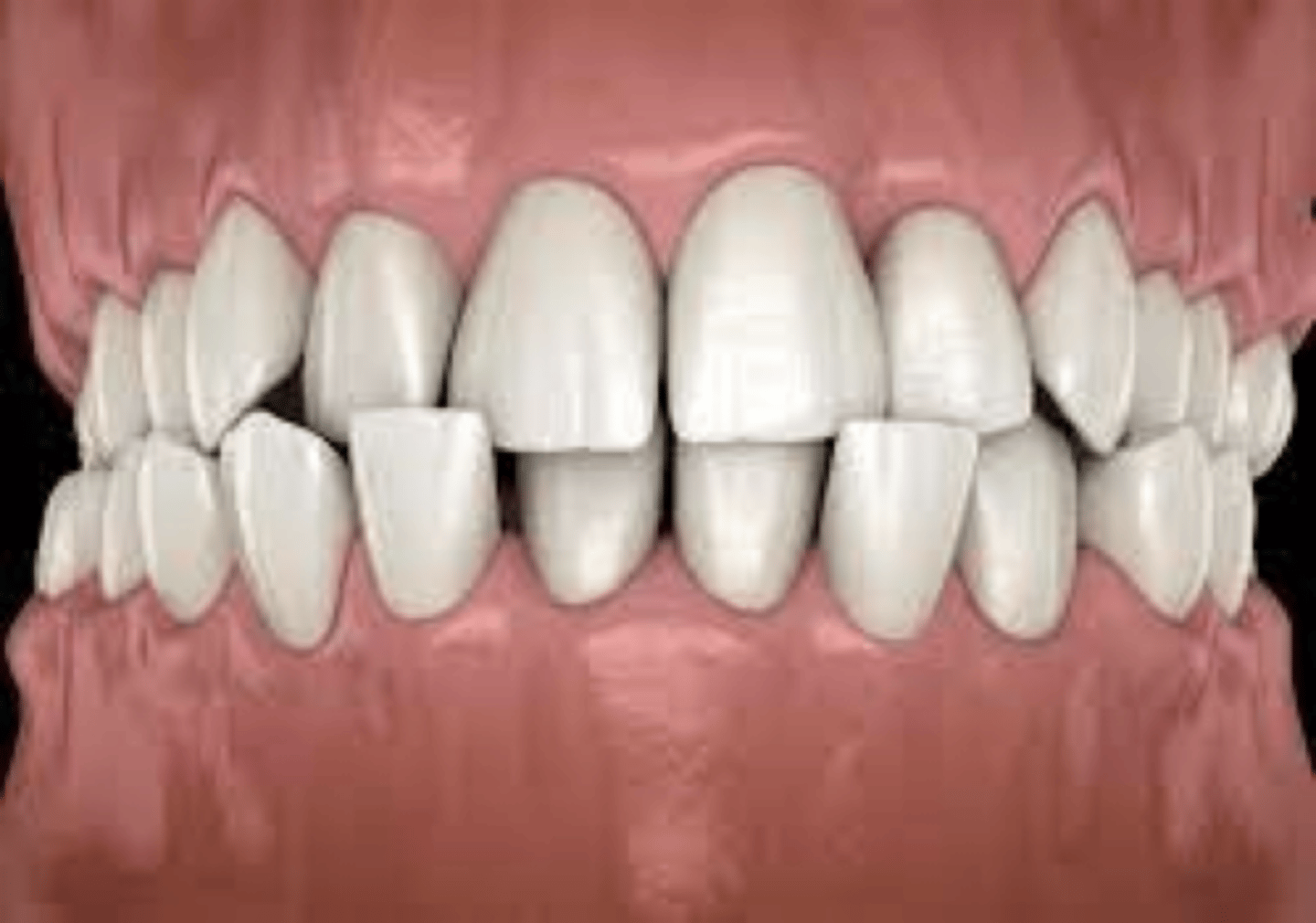 <p>tooth is not properly aligned with opposing tooth</p>