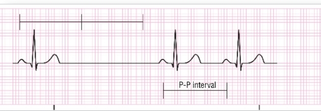 <ul><li><p>SA node fails to initiate an impulse.</p></li><li><p>SA node resumes normal functioning.</p></li><li><p>Occasional episodes are not significant.</p></li><li><p class="has-focus">Treatment based on the overall HR and tolerance</p></li></ul><p></p>