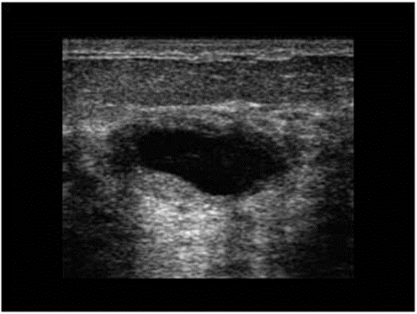 <p>30-50 yo</p><p>Regress after menopause</p><p>Single or multiple</p><p>Round</p><p>Soft/firm, rubbery</p><p>Well -demarcated</p><p>Mobile</p><p>Often tender</p>