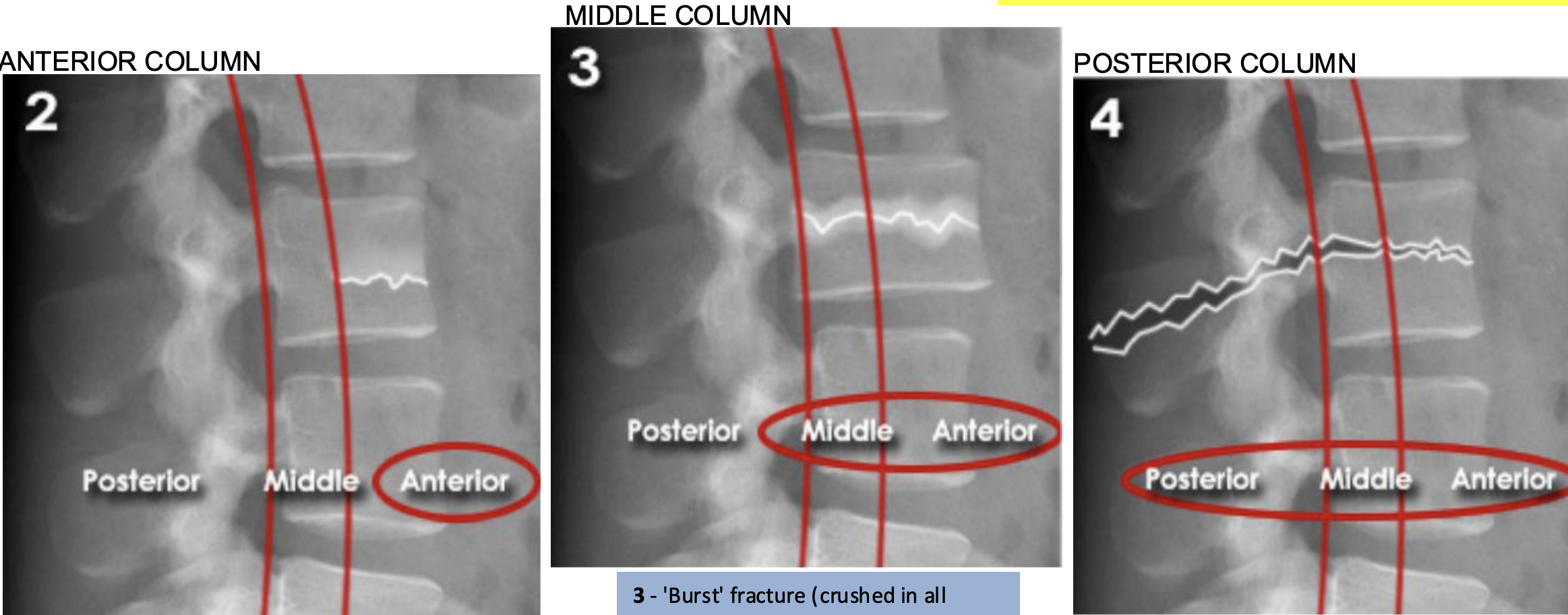 <ul><li><p>Divides the spine into three columns: anterior, middle, and posterior&nbsp;</p></li><li><p>Used to determine the stability of thoraco-lumbar spine fractures&nbsp;</p></li><li><p>severity depends on how many columns are implicated</p></li><li><p>If spinal instability is suspected further imaging with CT or MRI should be considered</p></li></ul><ol start="2"><li><p>ANTERIOR (Stable): </p><ul><li><p>Anterior compression injury</p><p>e.g. compression fractures (most common)</p></li></ul><ul><li><p>between the anterior longitudinal ligament to the middle of the vertebral body</p></li></ul></li><li><p>MIDDLE (unstable): </p><ul><li><p>'Burst' fracture (vertebral body crushed in all directions) due to axial loading</p></li></ul><ul><li><p>between middle of vertebral body to posterior longitudinal ligament</p></li></ul></li><li><p>POSTERIOR (unstable): </p><ul><li><p>Flexion-distraction fracture (caused by severe compression or rotation)</p></li><li><p>between posterior longitudinal ligament to spinous process</p></li><li><p><u>spinal cord implicated</u></p></li></ul></li></ol><p></p>