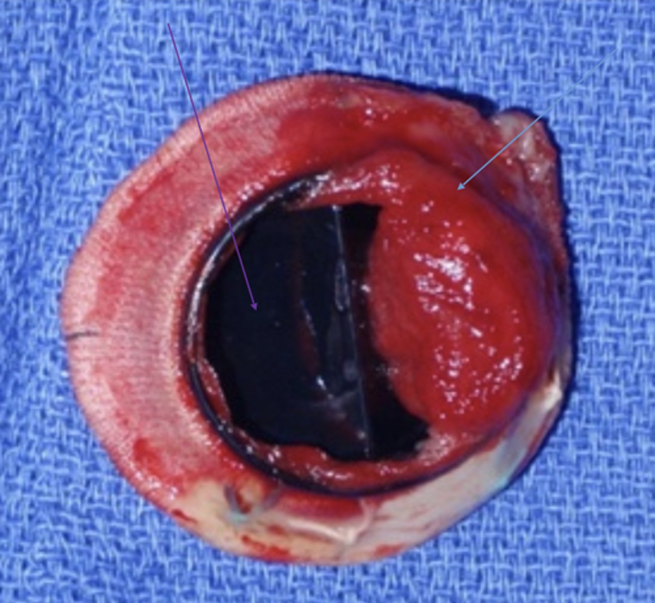 <p>More common in mechanical valves</p><p>Can restrict valve movement</p><p>Thromboembolism possible</p>