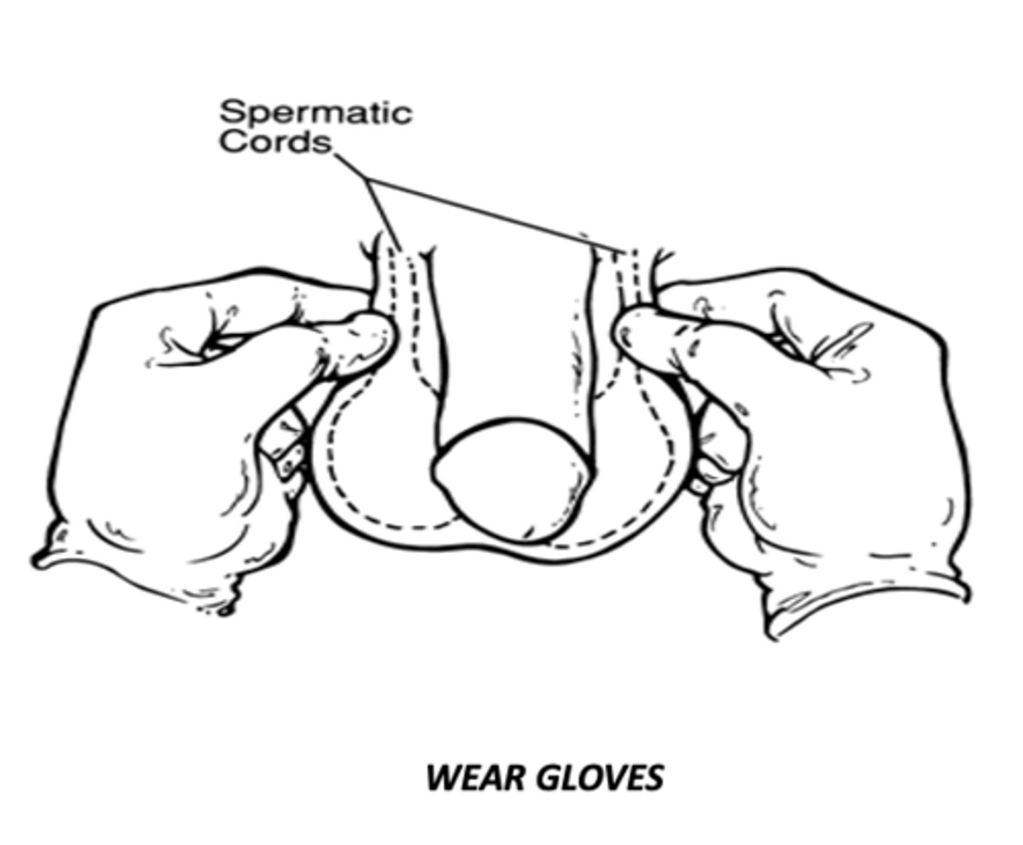 <p>method to examine the spermatic cord</p>