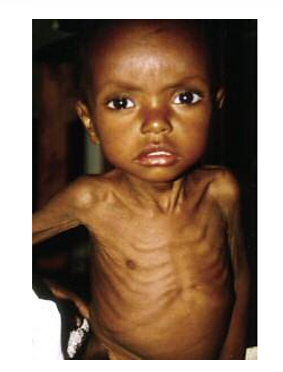 <p>En form av akut malnutrition. </p><p><strong>Brist på totalt kaloriintag råder</strong>, och ofta även brist på protein och andra näringsämnen. </p><p>Inga fettdepåer finns.</p><p>Barn med detta får hypoglykemi, hjärtsvikt, hypotermi och infektioner.</p>