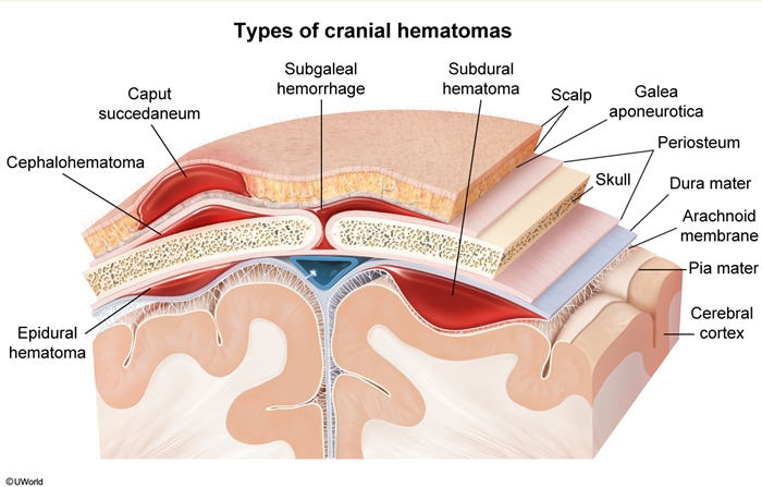 <p>hemorrhage involving the dural sinuses &amp; scalp, leading to massive blood accumulation between the periosteum and galea aponeurotica </p><p></p><p>diffuse, fluctuant scalp swelling that extends beyond suture lines and potentially to the neck; expands over 2-3 days, can lead to hypovolemic shock, DIC, and death → supportive care required</p>