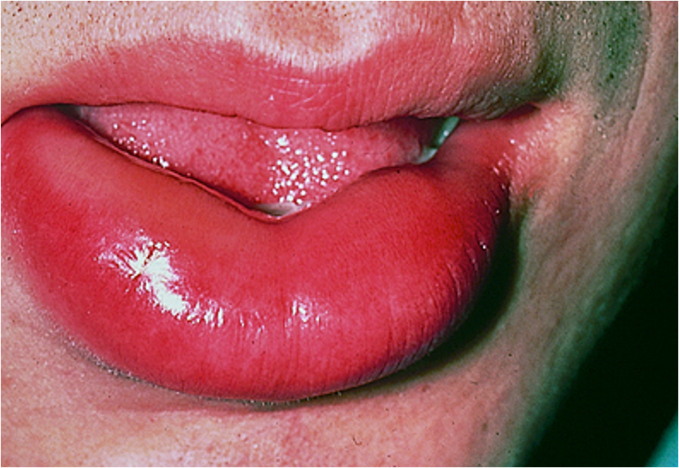 <p>acute, self limited, localized SC or submucosal swelling, which results from extravasation of fluid into interstitial tissues</p><p>location: face, lips, larynx, bowel, genitalia</p>