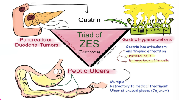 <p><strong>Zollinger Ellison Syndrome (Gastrinoma): Symptoms</strong></p><p>-___ with multiple refractory ulcers</p><p>-Diarrhea, heartburn, and weight ____ are other common symptoms</p><ul><li><p>The diarrhea is specifically __________, which is loose fatty stools </p></li></ul><p>-Complications → ________, stricture, perforation</p>