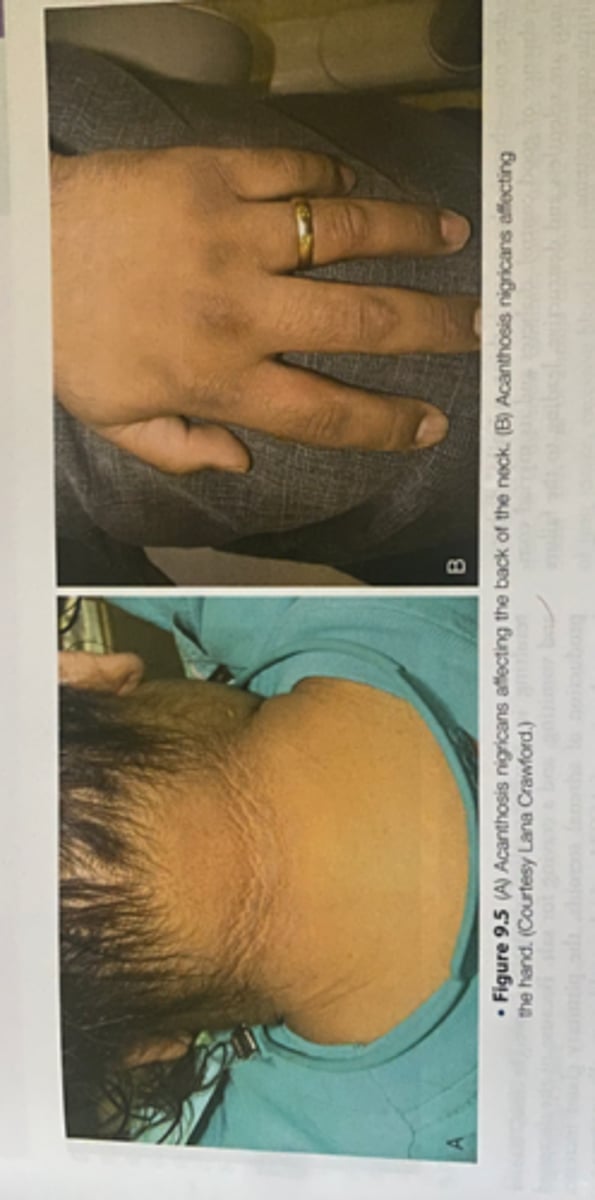 <p>-skin disorder</p><p>-has been reported to be associated with type 2 diabetes</p>