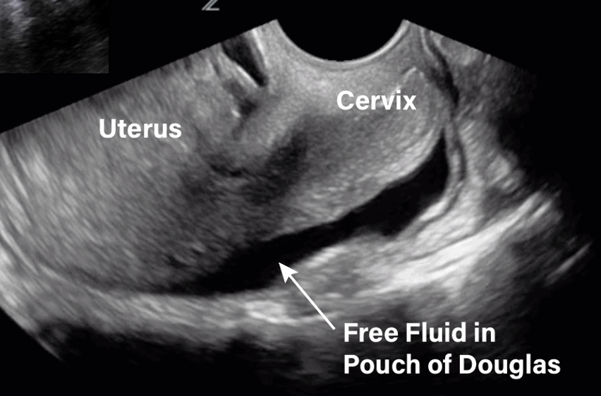 <p><span>What amount of fluid can be seen in posterior cul de sac transvaginally?</span></p>