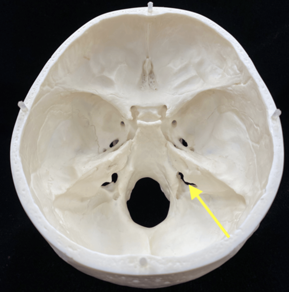 <p>name the bone and bone feature </p>