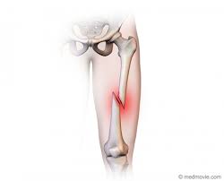 <ul><li><p>a fracture in which the bone is broken at an angle across the bone </p></li><li><p>usually the result of a sharp, angled blow to the bone </p></li></ul><p></p>