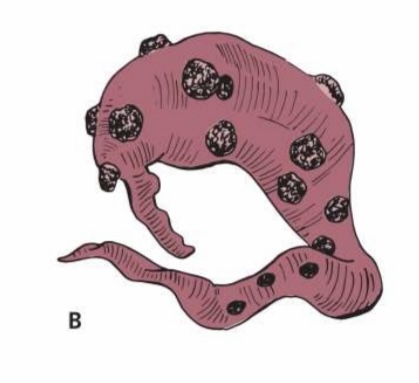 What type of placenta is this?