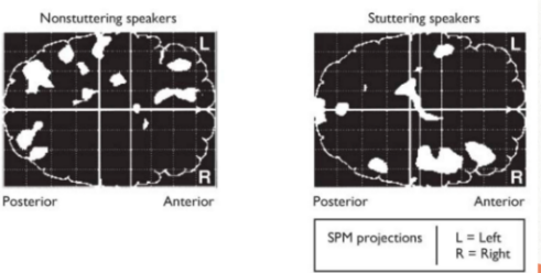 <ul><li><p style="text-align: justify;"><span>Neuroimaging studies showed a great deal of <strong>_ of _ structures typically active for speech, such as white matter tracts&nbsp;</strong></span></p></li><li><p><span>These images show us a positron emission tomography or PET scan of brains of people who do not stutter (Left picture) and person who stutters (Right picture) while reading aloud&nbsp;</span></p></li><li><p style="text-align: justify;"><span>Statistical parametric mapping which is a quantitative neuroimaging method for analysing functional and structural brain data to identify differences in brain activity or tissue&nbsp;</span></p><ul><li><p style="text-align: justify;"><span>You can see that non stuttering speakers placed more activity on the left side of the brain whenever they read a loud&nbsp;</span></p></li><li><p style="text-align: justify;"><span>For stuttering speaker there is a greater activity on the right side of the brain whenever they read aloud&nbsp;</span></p></li></ul></li></ul><p></p>