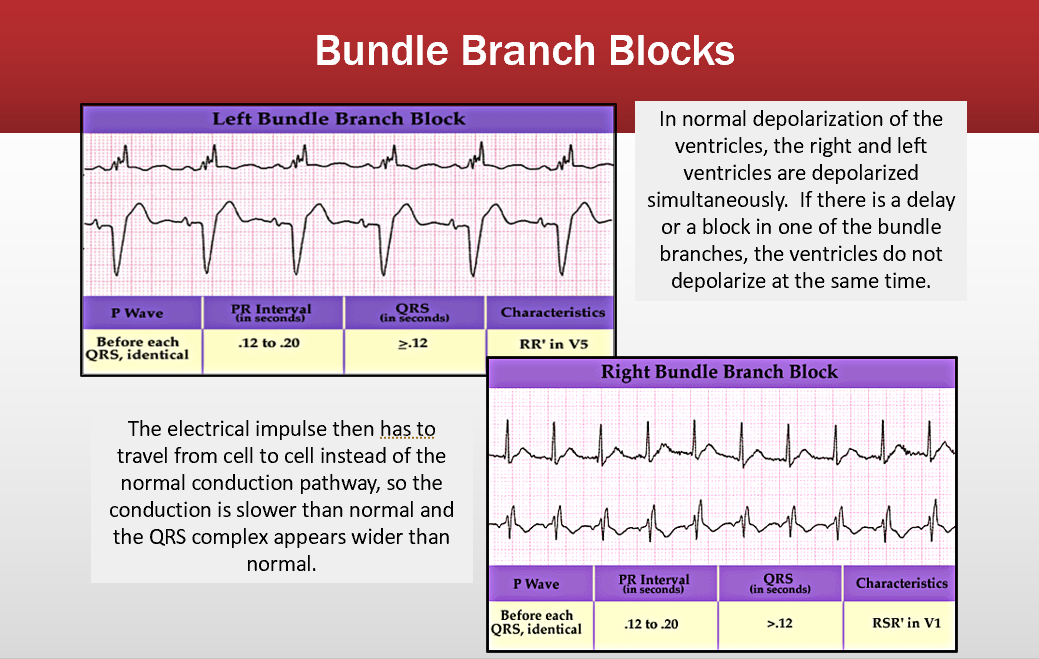 <p>qrs is longer than .12</p>