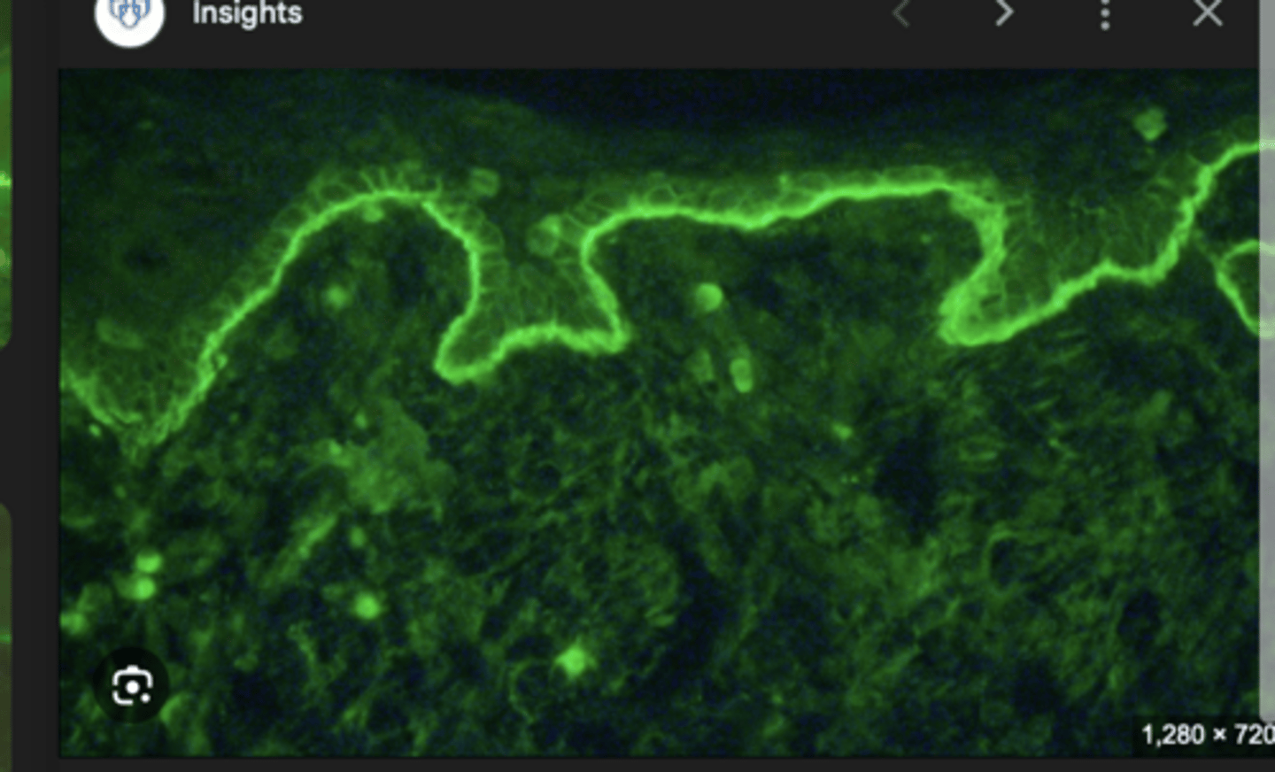 <p>Autoantibodies targeting the hemidesmosomes that bind the basal keratinocytes of the epidermis to the basement membrane.</p>