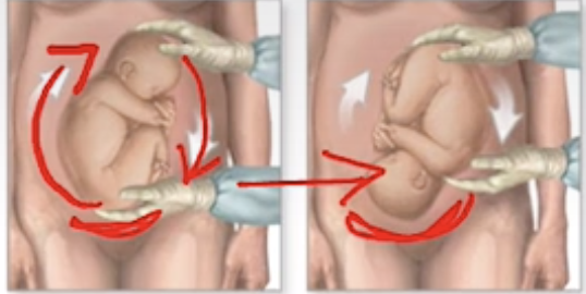 <p>External Cephalic Version</p>