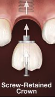 <p>What kind of crown is implant supported?</p>