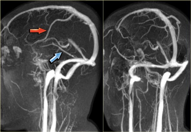 <p>What is the purpose of a CT Venogram?</p>