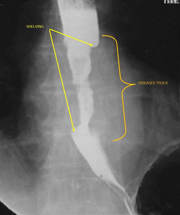 <p>What is 'shelving' in esophageal carcinoma?</p>