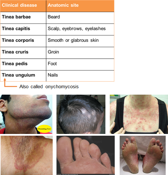 <ul><li><p class=""><strong>Tinea barbae</strong>: beard area</p></li><li><p class=""><strong>Tinea corporis:</strong> body (ringworm)</p></li><li><p class=""><strong>Tinea manuum</strong>: hand</p></li><li><p class=""><strong>Tinea cruris</strong>: groin ("jock itch")</p></li><li><p class=""><strong>Tinea pedis</strong>: feet ("athlete’s foot"), often causes <strong>maceration and fissures</strong>, especially <strong>between the toes</strong></p></li><li><p class=""><strong>Tinea unguium</strong>: nails</p></li></ul><p></p>