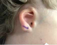 <p><span>This  child appears to have microtia with what other condition? </span></p>