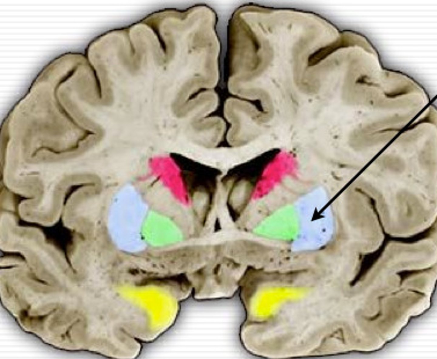 <p>lateral "shell" oof basal ganglia with cellular bridges to caudate nucleus</p><p>also major input in basal ganglia</p>