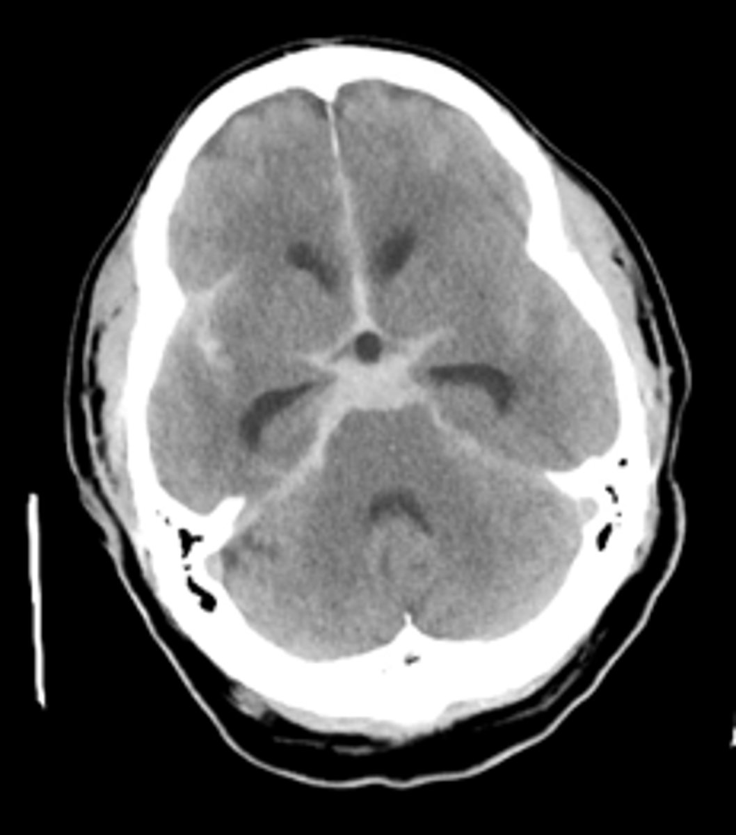 <p>CT dry scan... looks like "clown nose", star of death</p><p>subarachnoid hemorrhage</p><p>(worst HA of life)</p>