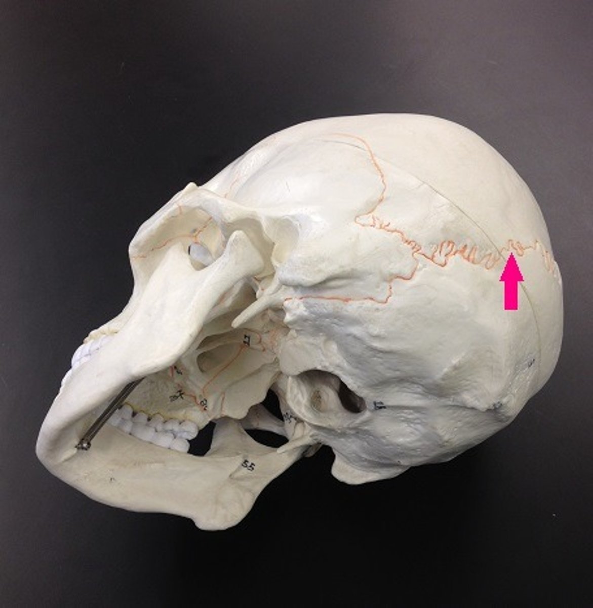 <p>Identify the suture.</p>