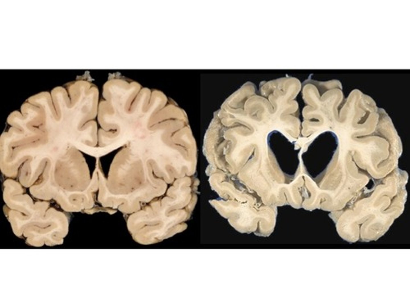 <p>Define Condition:</p><p>Trinucleotide repeat produces a “toxic gain of function,” affectingthe protein “Huntingtin,” on Chromosome 4p.</p><p>-Hx: +FHx of early-onset dementia w/ dyskinesias due to AD of high penetrance; Onset in 40s-50s (but issues in childhood)</p><p>-Sx: Gradual onset of "fidgetiness" (choreiform ataxia) --&gt; jerky movements, Personality changes</p><p>-PE: Jerks becoming incapacitating + personality changes</p><p>-Dx: Brain MRI (atrophy of the caudate nuclei + large ant horns of ventricles) + Genetic Testing (CAG trinucleotide repeats &gt; 38)</p><p>-Tx: Tx Chorea with Tetrabenazine (deplete monoaminergic synaptic vesicles, thus resetting a balance between dopamine/NE and ACh)</p>