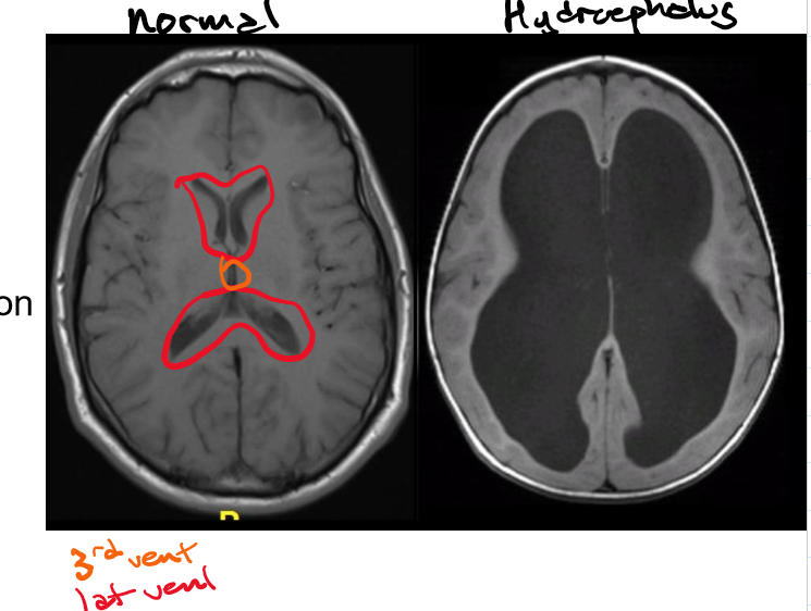 <p>Hydrocephalus and how it’s caused</p><p>Communicating and non-communicating: how they’re caused, examples and side effect of non-communicating </p>
