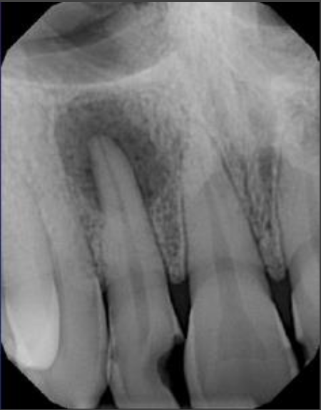 <p>Vary depending on the disease stage</p><ul><li><p>Early lesions</p><ul><li><p>Little to no change</p></li><li><p>Diagnosis may rely on pulp vitality tests and clinical signs/symptoms</p></li></ul></li><li><p>Lamina dura becomes less distinct or lost and PDL widens</p><ul><li><p><strong>Periapical radiolucency (PARL)</strong></p></li></ul></li><li><p>Longer-standing lesions</p><ul><li><p>Radiolucent region at apex</p></li><li><p>More diffuse surrounding area of radiopacity</p></li></ul></li></ul><p></p>