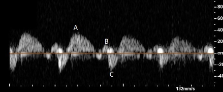 <p>Label this IVC flow pattern</p>