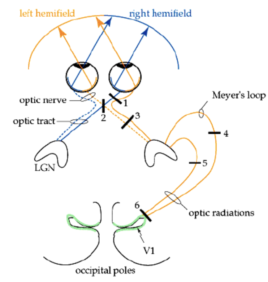 <ol start="2"><li><p>Lesion optic chasm in midline</p></li></ol>