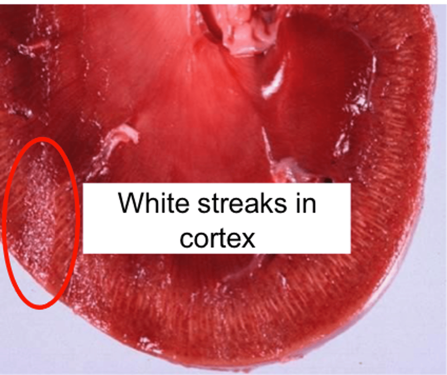 <p>White streaks in the renal cortex</p>