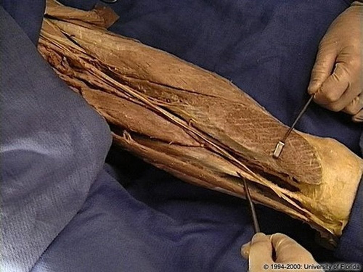 <p>Origin: Ischial tuberosity</p><p>Insertion: ADductor tubercle of femus</p>