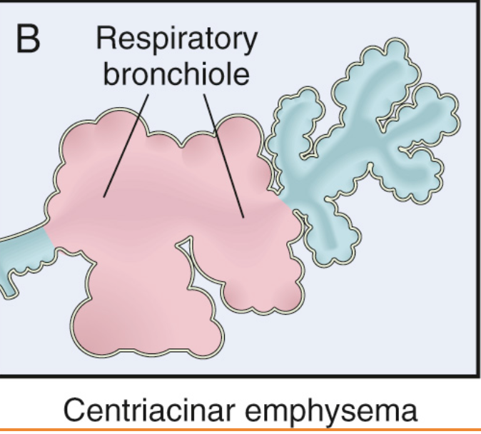 <p>¿A qué se asocia el enfisema centroacinar y en qué zona del pulmón tiende a ocurrir?</p>