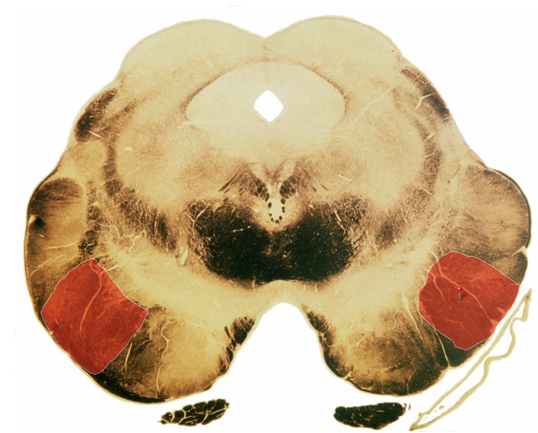 <p>Corticospinal Tract </p>