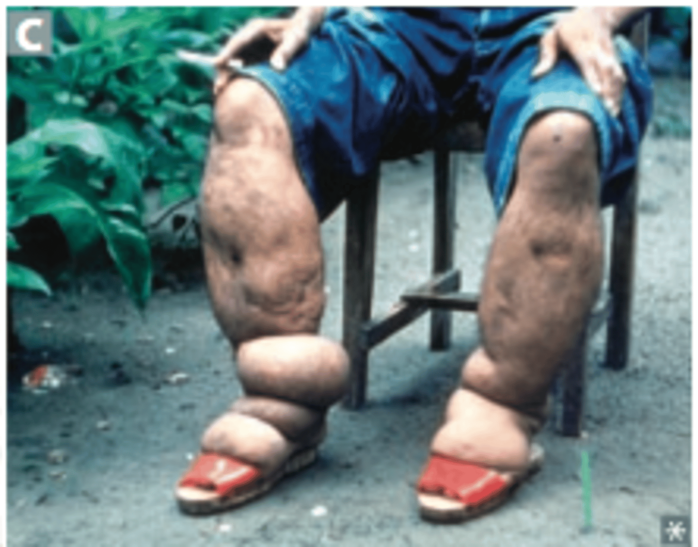 <p>swelling due to an abnormal accumulation of fluid in the tissues that occurs when lymph vessels do not drain properly</p>