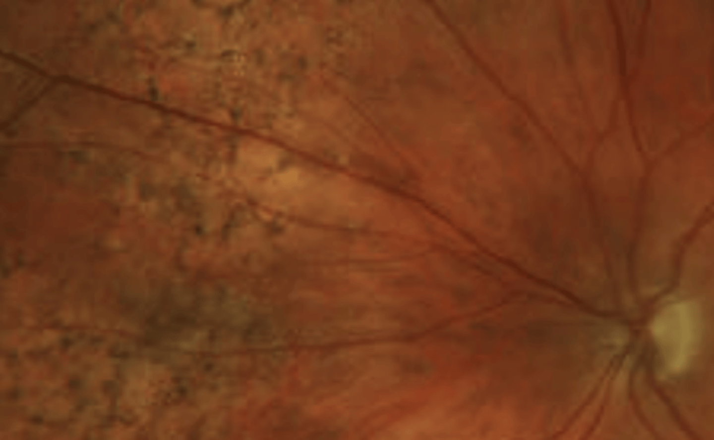 <p>peripheral RPE degeneration appearing as granular "bone spicule" piment between the ora and equator in 20% of the population over 40 yo. Is usually bilateral. Is benign with no associated risks indicating monitoring sufficient management.</p>