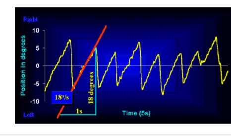 <p><strong>Golfvorm:</strong></p><ul><li><p><strong>Jerk nystagmus:</strong></p><ul><li><p>Snelle + trage fase → <strong>bifasisch</strong>.</p></li></ul></li><li><p><strong>Pendulaire nystagmus:</strong></p><ul><li><p>Gelijke snelheid beide richtingen → <strong>sinusoïdaal</strong>.</p></li><li><p><strong>Wijst op centrale (niet-vestibulaire) oculaire stoornis</strong>.</p></li></ul></li></ul><p><strong>Richting:</strong></p><ul><li><p>Links / Rechts (vanuit <strong>patiëntstandpunt</strong>).</p></li><li><p>Boven / Onder.</p></li><li><p>Rotatie: <strong>horaire (met klok)</strong> of <strong>antihoraire (tegen klok)</strong> (vanuit jouw standpunt).</p></li></ul><p>Intensiteit</p><ul><li><p><strong>Amplitude:</strong> snelheid trage fase = <strong>Slow Component Velocity (SCV)</strong></p><ul><li><p>>7°/s =pathologisch</p></li></ul></li></ul><ul><li><p>Frequentie: aantal nystagmusslagen</p><ul><li><p>7°/s maar slechts enkele slagen → minder relevant.</p></li><li><p><7°/s maar zeer regelmatig → verdacht</p></li></ul></li></ul><p><strong><u>Spontane nystagmus moet consistent aanwezig zijn tijdens ENG.</u></strong></p><p><strong><u>Enkel SN op één onderdeel → niet betrouwbaar</u></strong></p>