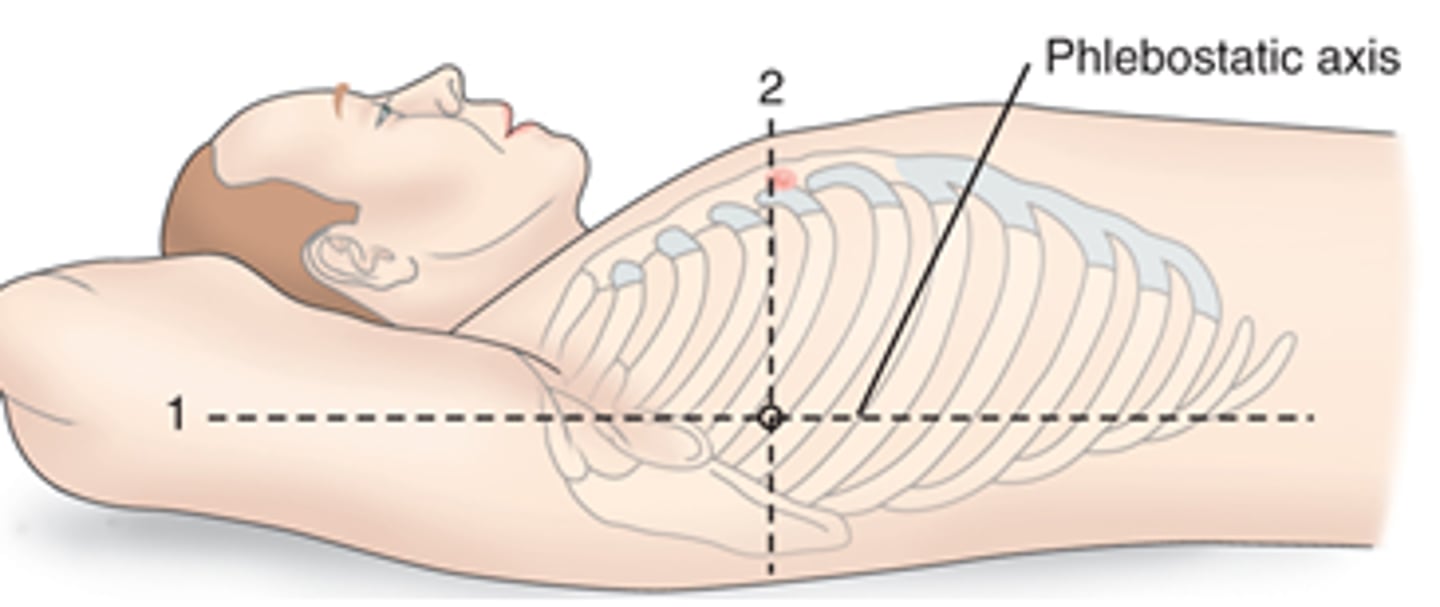 <p>Phlebostatic axis</p><p>The phlebostatic axis is located at the fifth intercostals space midaxillary line and is the correct placement of the manometer. The PMI or point of maximal impulse is located at the fifth intercostals space midclavicular line, so answer B is incorrect. Erb’s point is the point at which you can hear the valves close simultaneously, making answer C incorrect. The Tail of Spence (the upper outer quadrant) is the area where most breast cancers are located and has nothing to do with placement of a manometer</p>