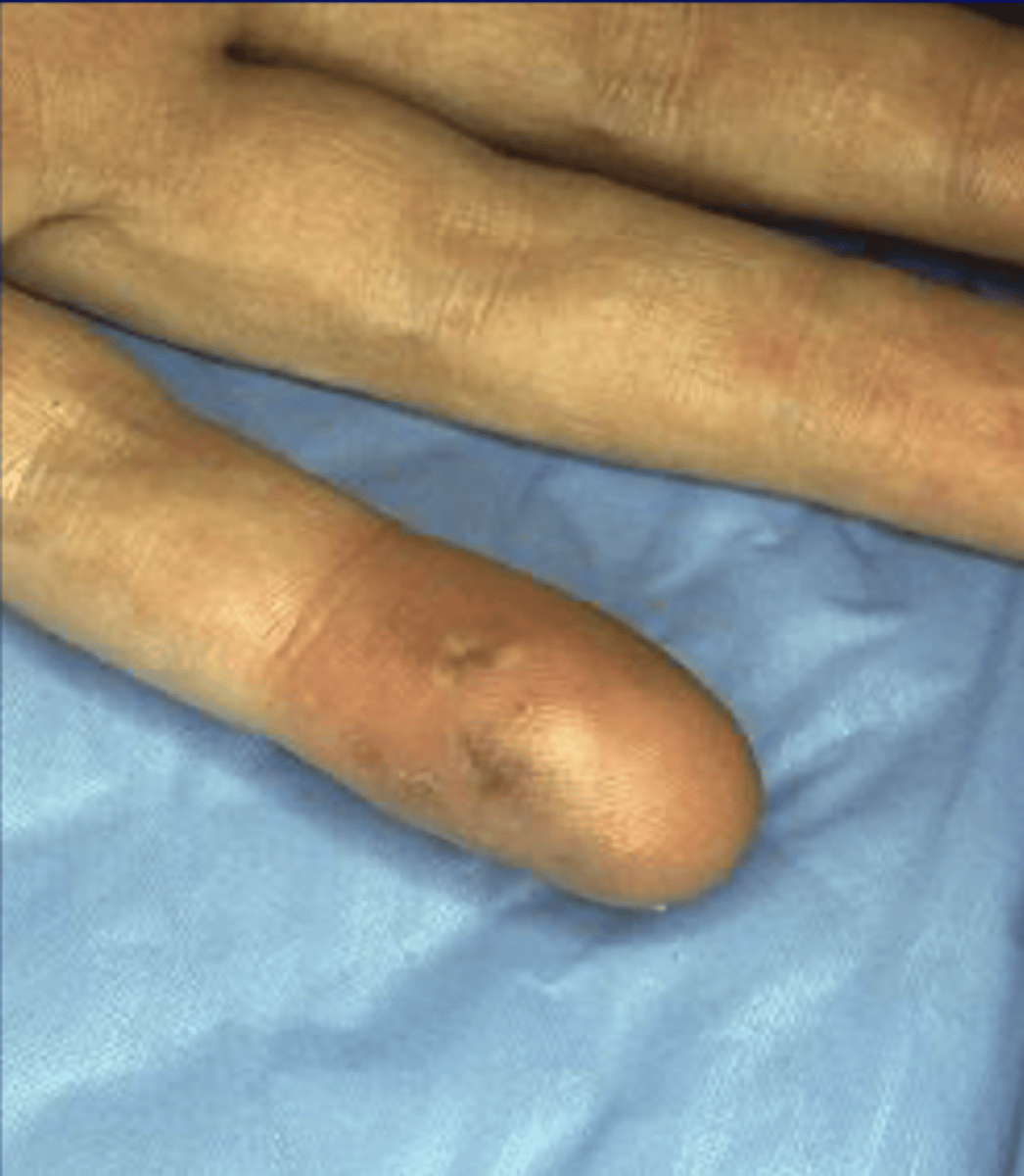 <p>small tender nodules usually found on the finger and toe pads</p>