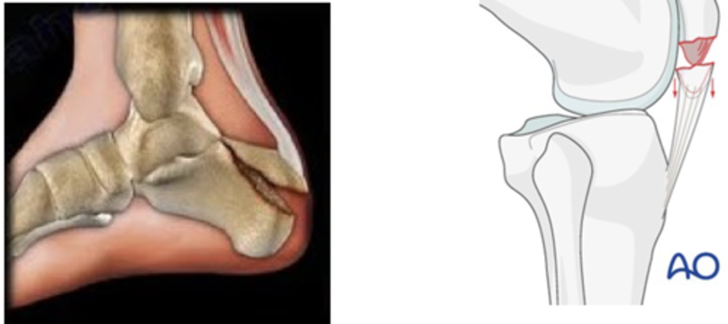 <p>Where tendon attaches to bone</p><p>- Common site of avulsion fracture</p>