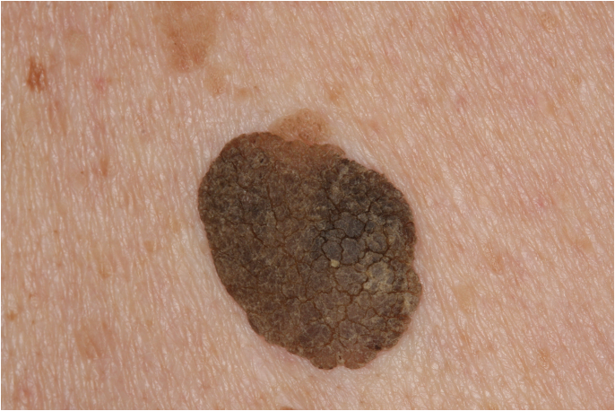 <p>Seborrheic Keratosis </p>
