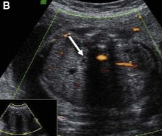 <p>The fetus scanned on was seen with a single umbilical artery wrapped around the bladder. That prompted the sonographer to take a look at the kidneys and this was seen. </p><ol><li><p>What pathology can be assumed here?</p></li><li><p>Why can this pathology happen?</p></li></ol><p></p>
