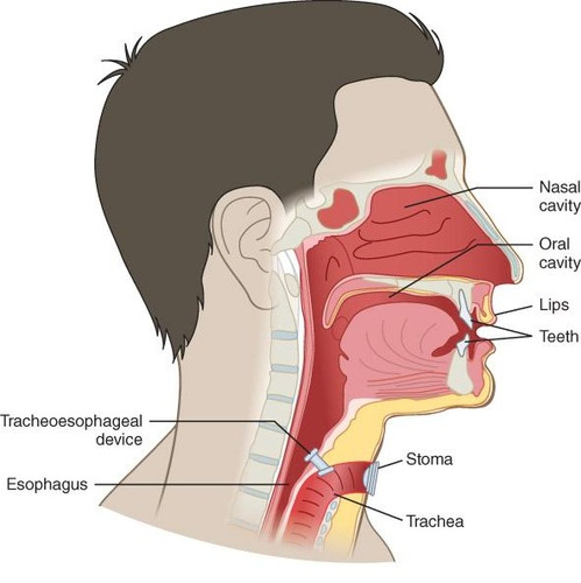 <p>A method of speech where air is trapped in the throat to produce sound after a laryngectomy.</p>
