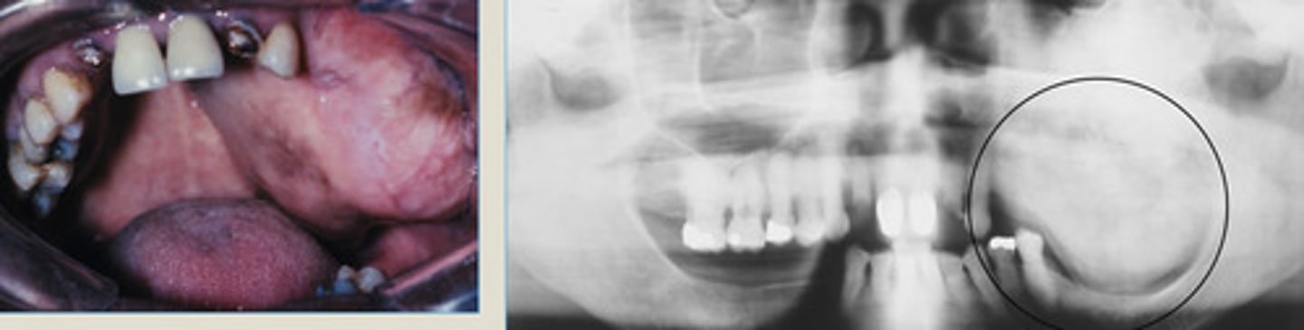 <p>Expansile mass of the left maxilla in a 45 yr old</p><p>Lesion known to be present for 20 yrs</p><p>Diffuse ground glass radiopacity</p>