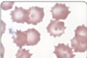 <p>Name this poikilocyte. What causes it</p>