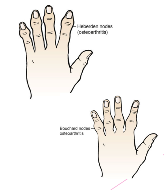 <p>Localized</p><ul><li><p>Joint pain</p></li><li><p>Crepitus with movement</p></li><li><p>Bony enlargement</p></li><li><p>Morning stiffness</p></li><li><p>Hand deformity</p><ul><li><p>Heberden</p></li><li><p>Bouchard nodes </p></li></ul></li></ul>