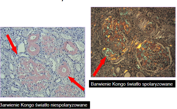 <p>amyloid gromadzi się w narządzie miąższowym między śródbłonkiem naczyń a nabłonkiem i uciska na naczynia (okołonaczyniowo) oraz w zrębie narządu (pozakomórkowo)</p>
